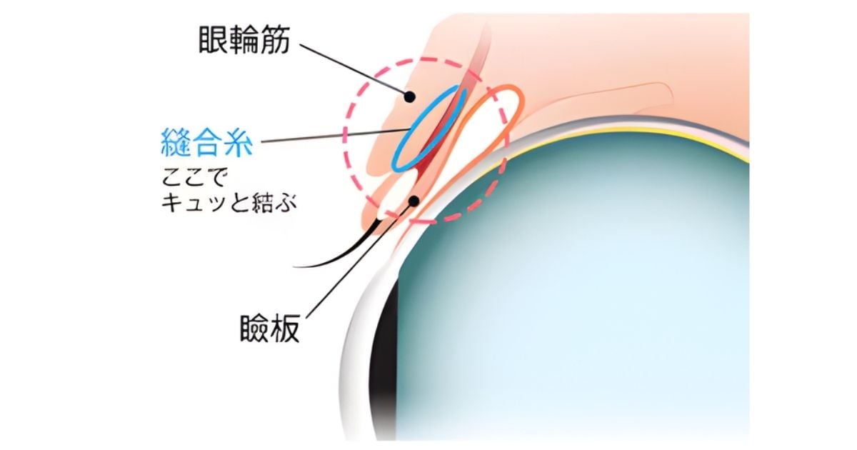 埋没法の中でも最も取れづらく、腫れづらく、バレにくい二重術<br />
