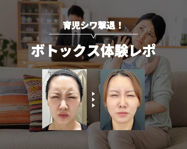 【体験レポ】35歳のリアル。育児で鍛えられた（？）表情筋にボトックス打ってみた！