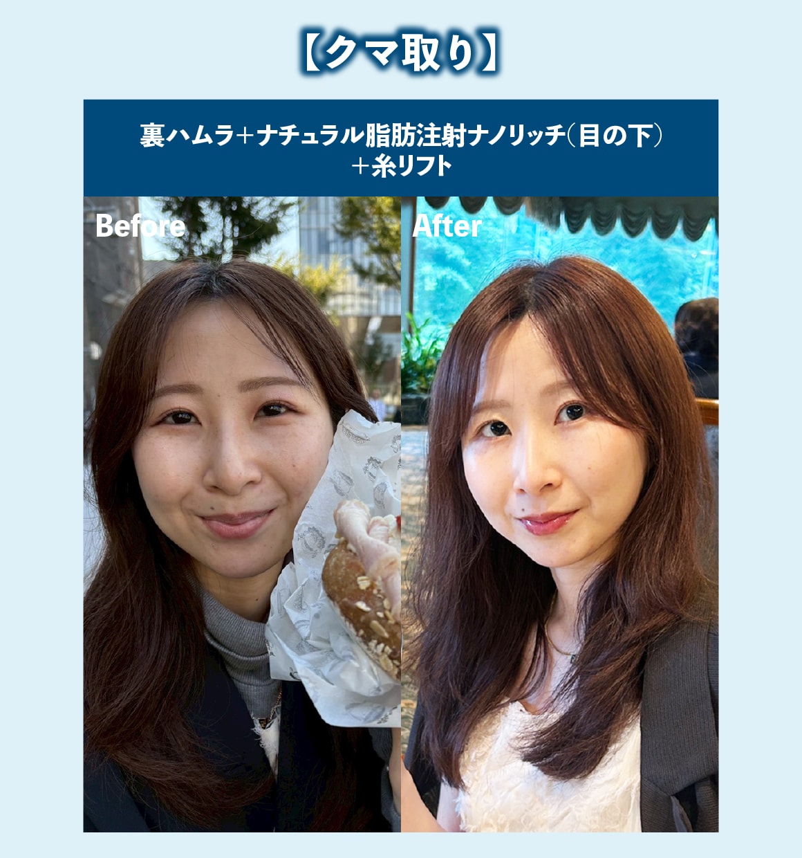 クマ取り