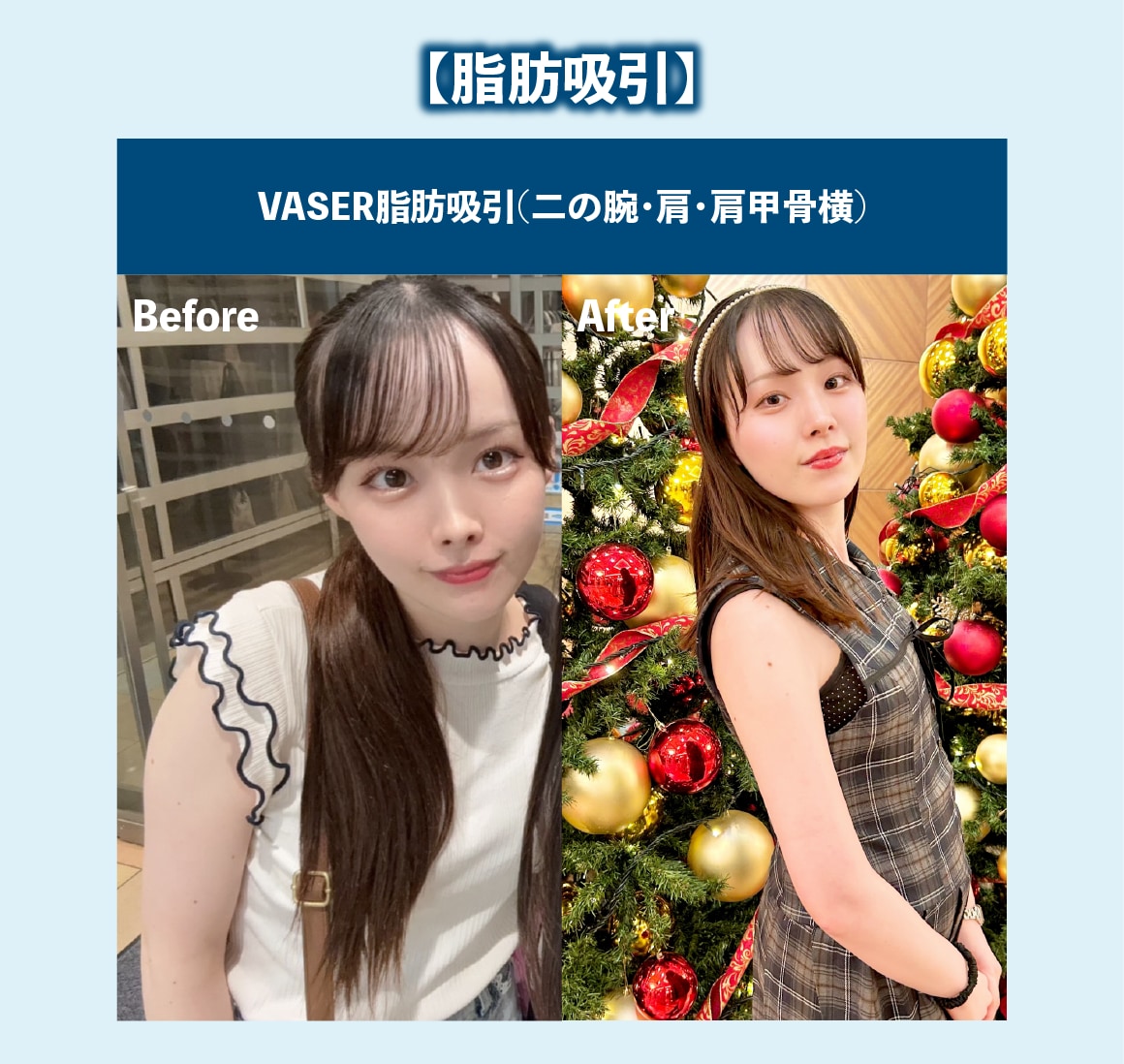 脂肪吸引