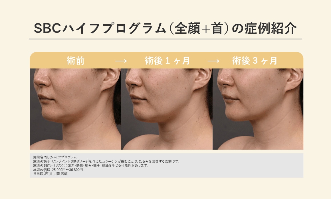 SBCハイフプログラム症例紹介