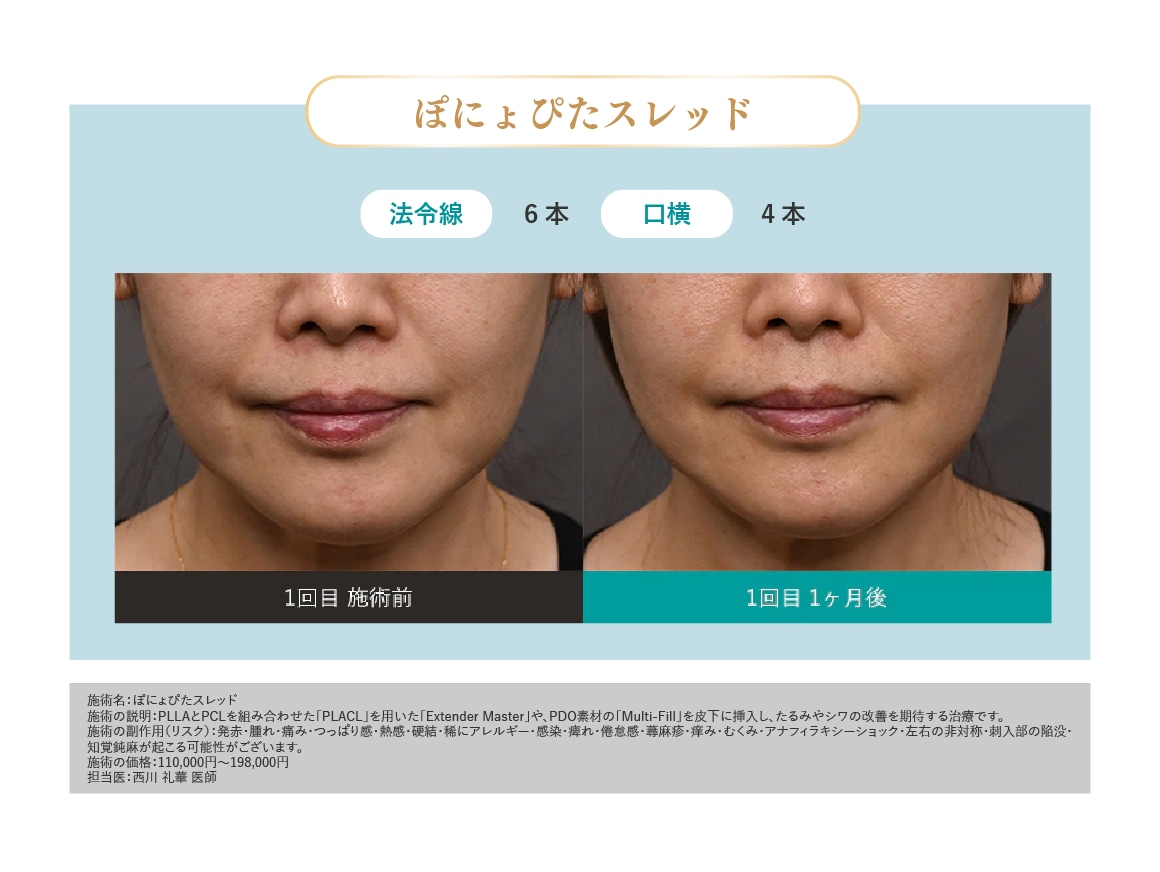 ぽにょぴたスレッド