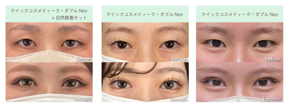 二重の症例写真