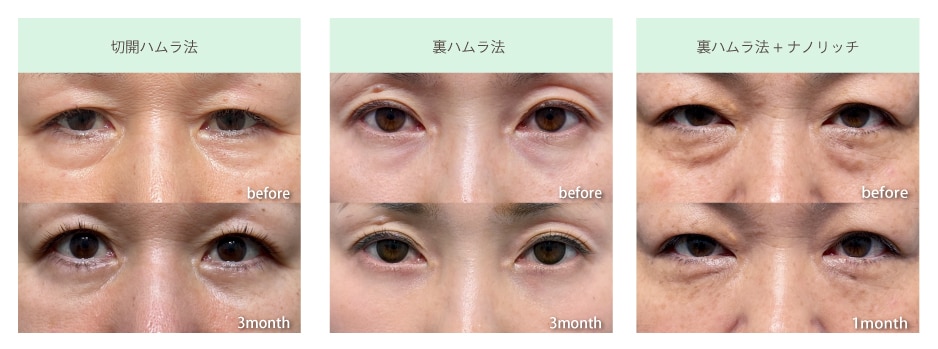 クマ取りの症例写真