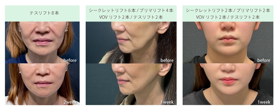 糸リフトの症例写真