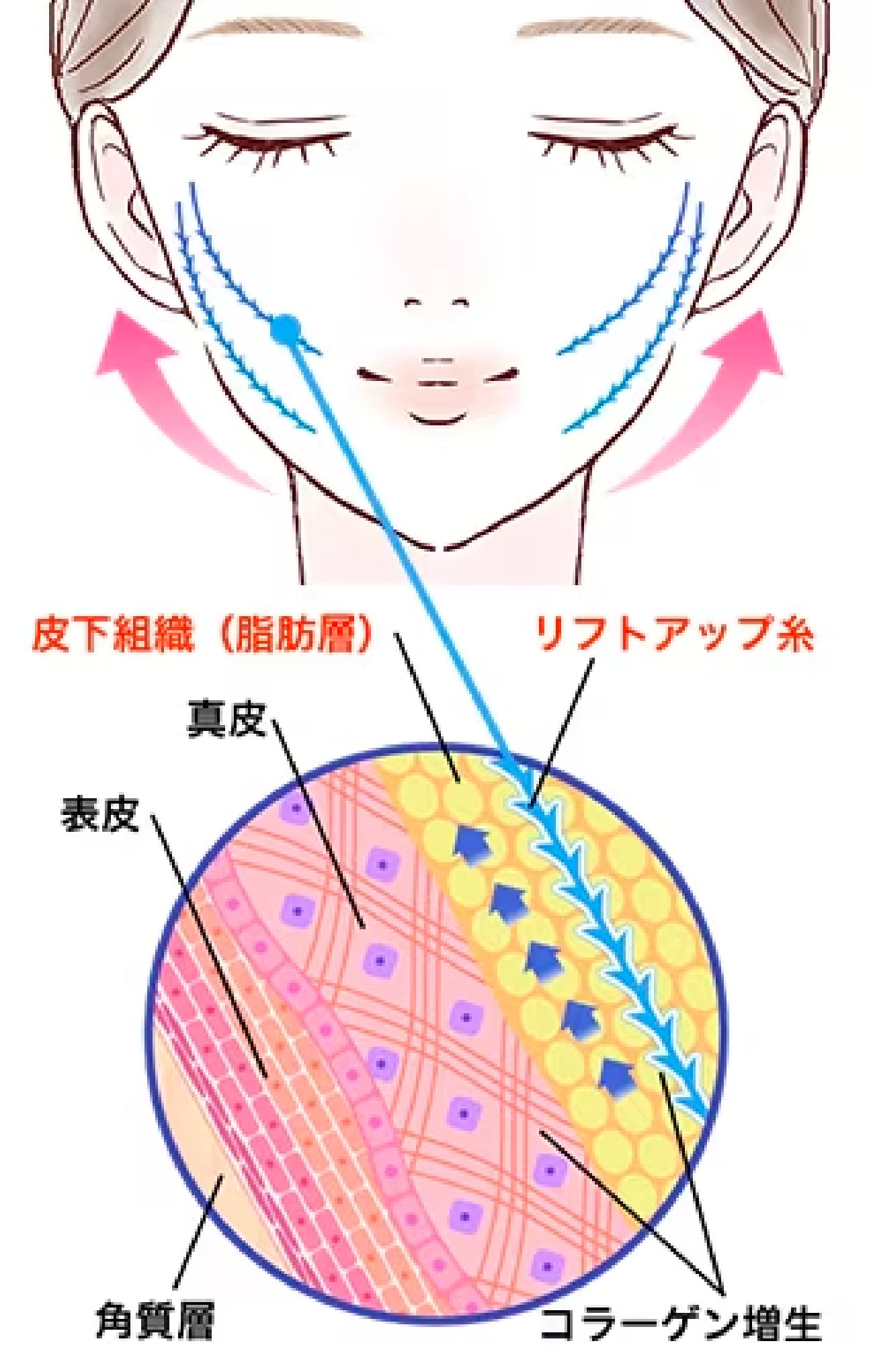 糸リフトって？