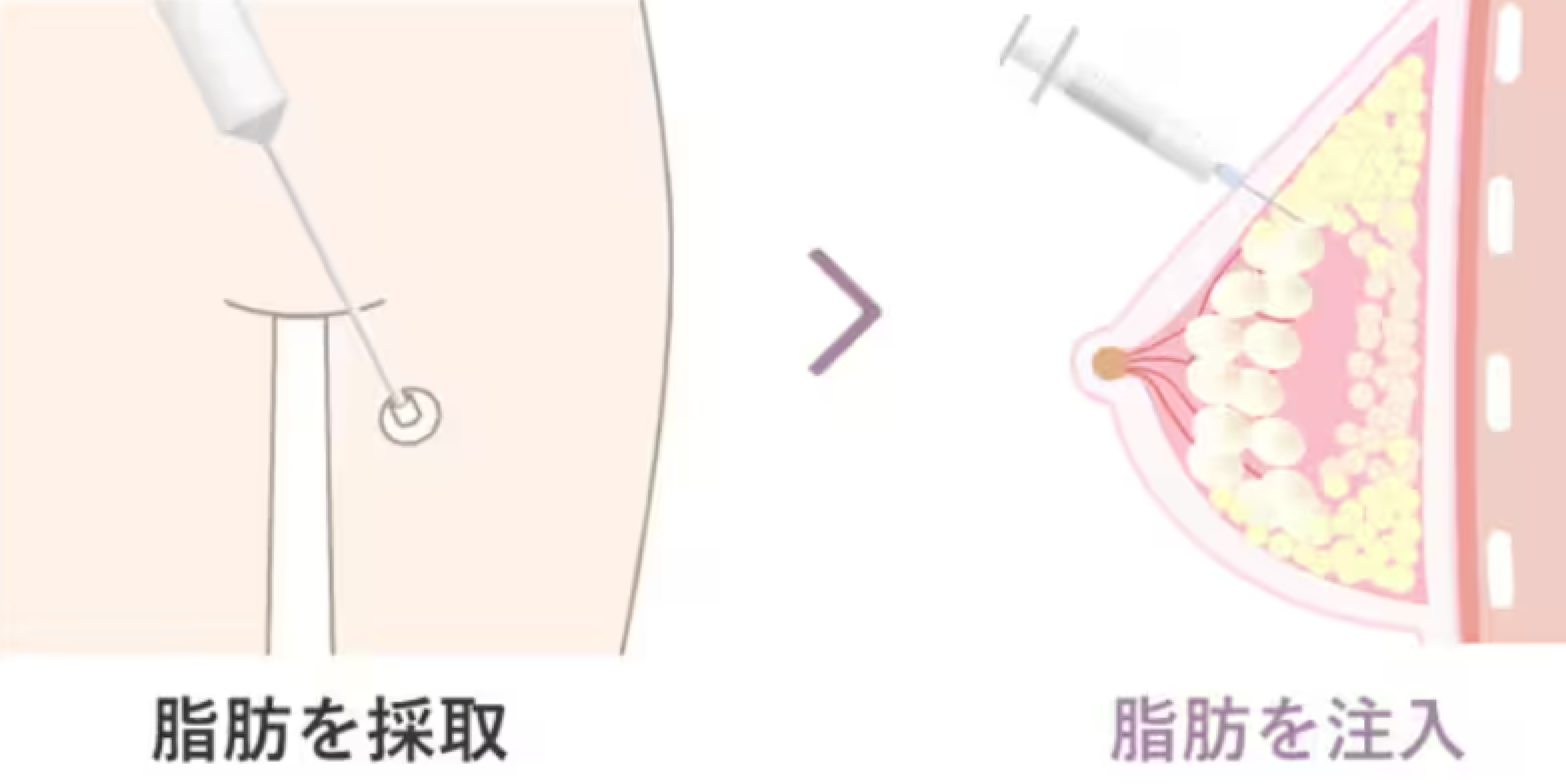 コンプレックスを自信に変える。部分痩せも叶う「自然な豊胸術」とは？