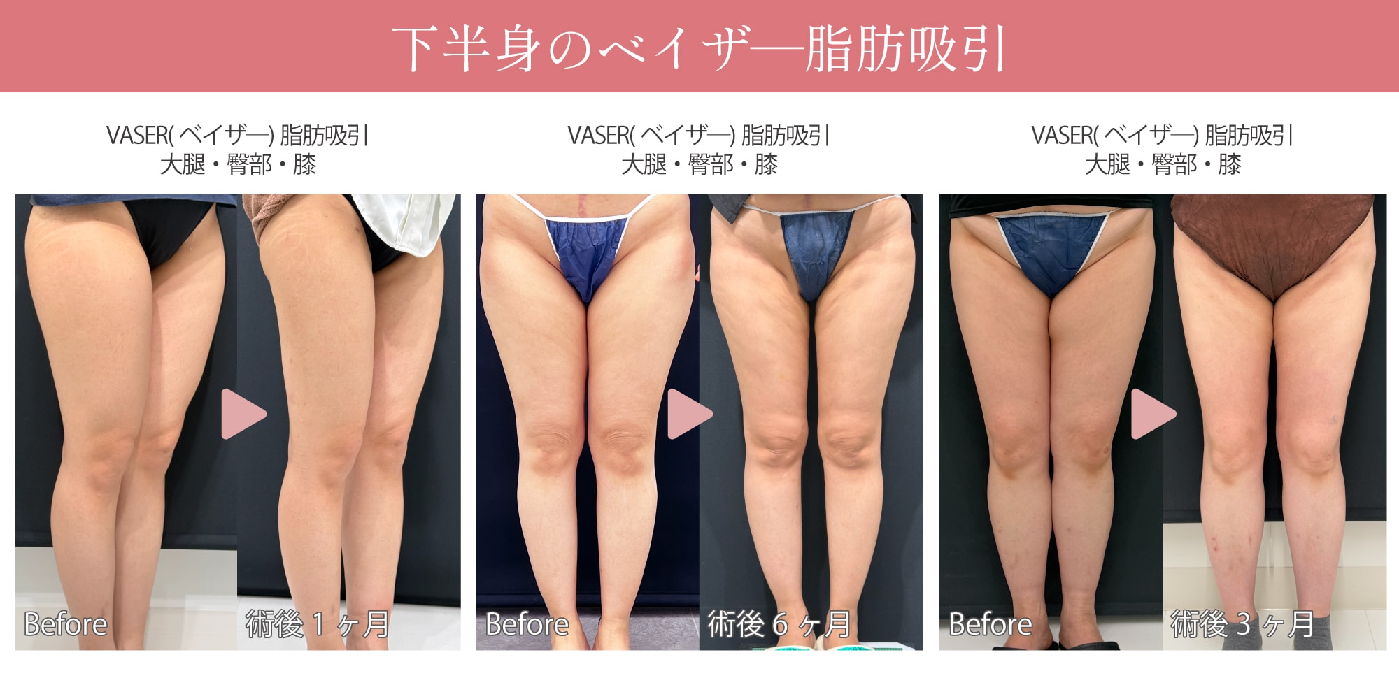 下半身(太もも・お尻・膝)の脂肪吸引の症例🦵