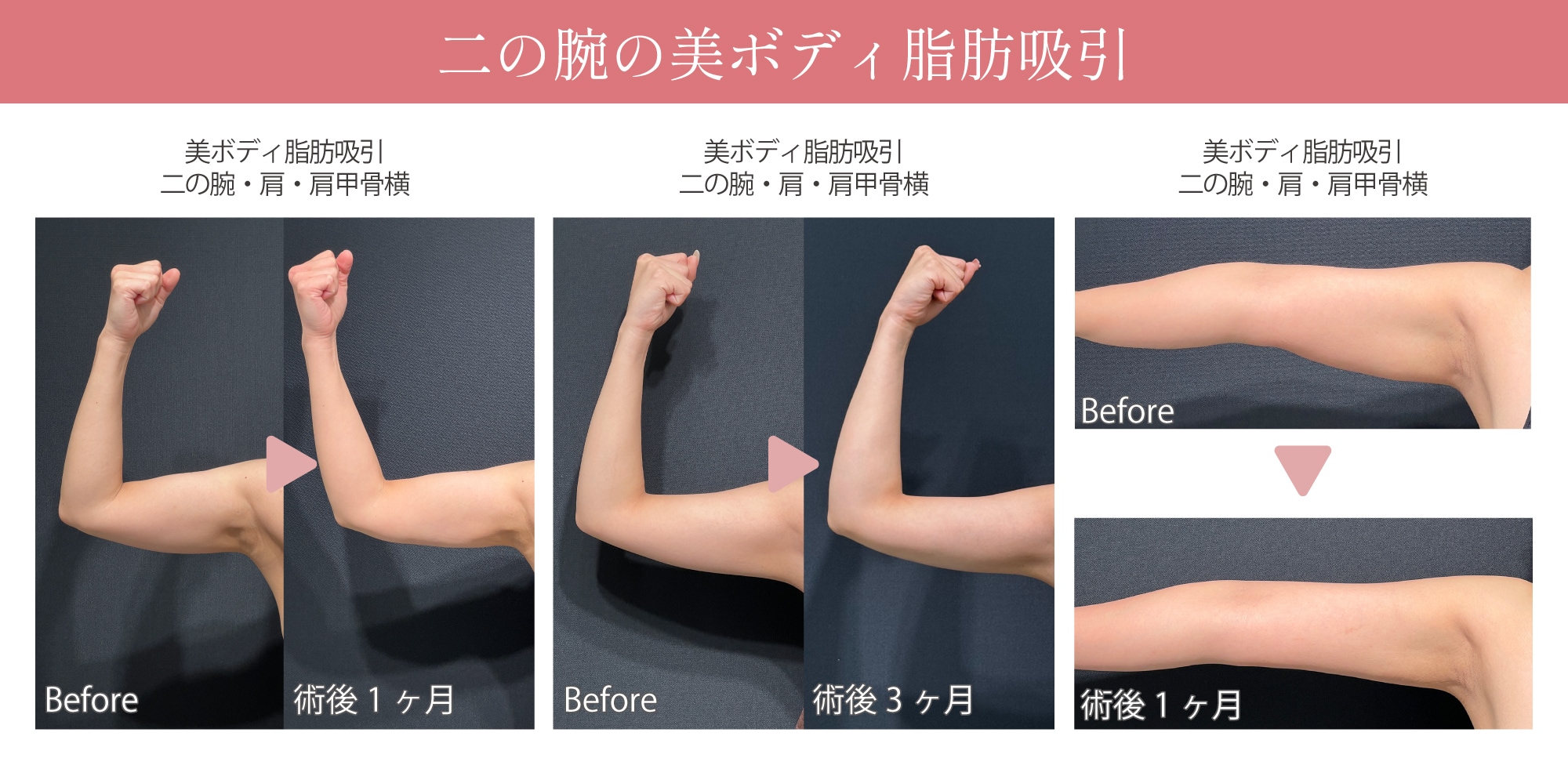 二の腕の脂肪吸引の症例💪