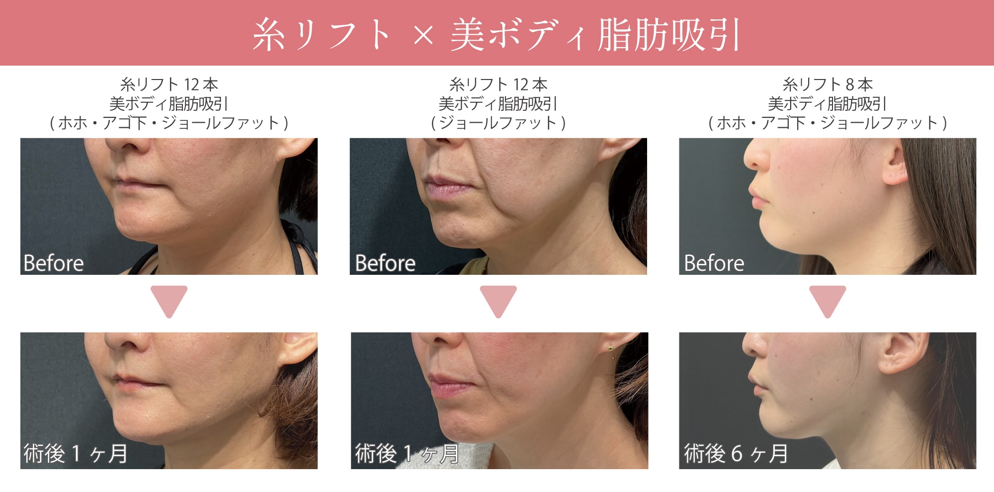 糸×脂肪吸引の若返り術が得意な先生