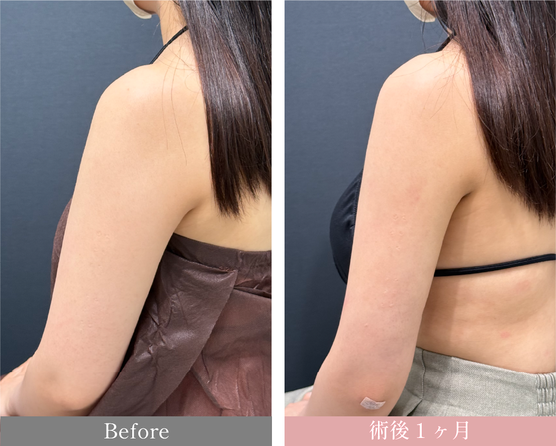 ベイザー脂肪吸引<br />
<small>二の腕全周＋肩＋上背部</small></p>