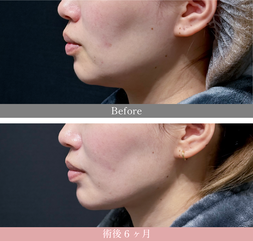 美ボディ脂肪吸引×糸リフト<br />
<small>美ボディ脂肪吸引(ホホ＋アゴ下＋ジョールファット)<br />
VOVリフト6本/プリマリフト2本/シークレットリフト2本</small></p>