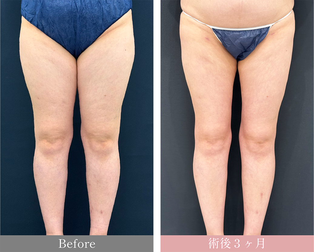 ベイザー脂肪吸引<br />
<small>太もも＋臀部＋膝</small></p>