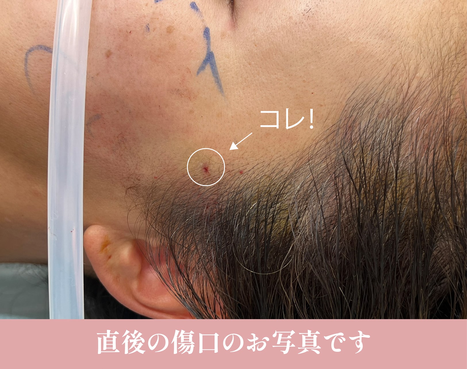 渡部医師の糸リフトはダウンタイムほぼ0‼️