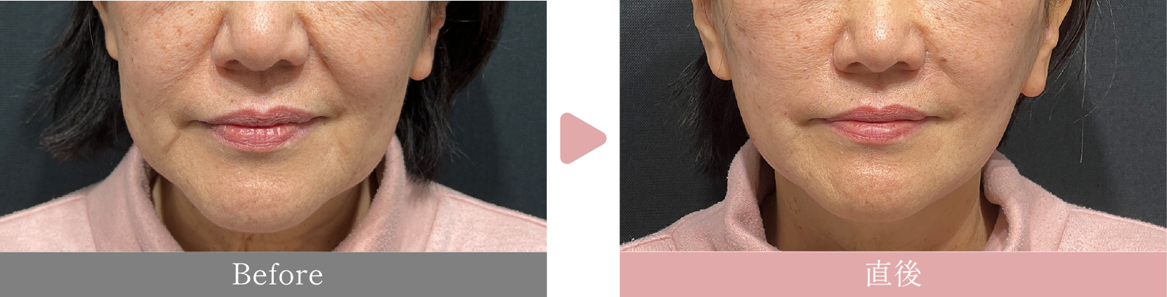 60代女性　カスタマイズ糸リフト18本×ほうれい線・口角下のヒアルロン酸