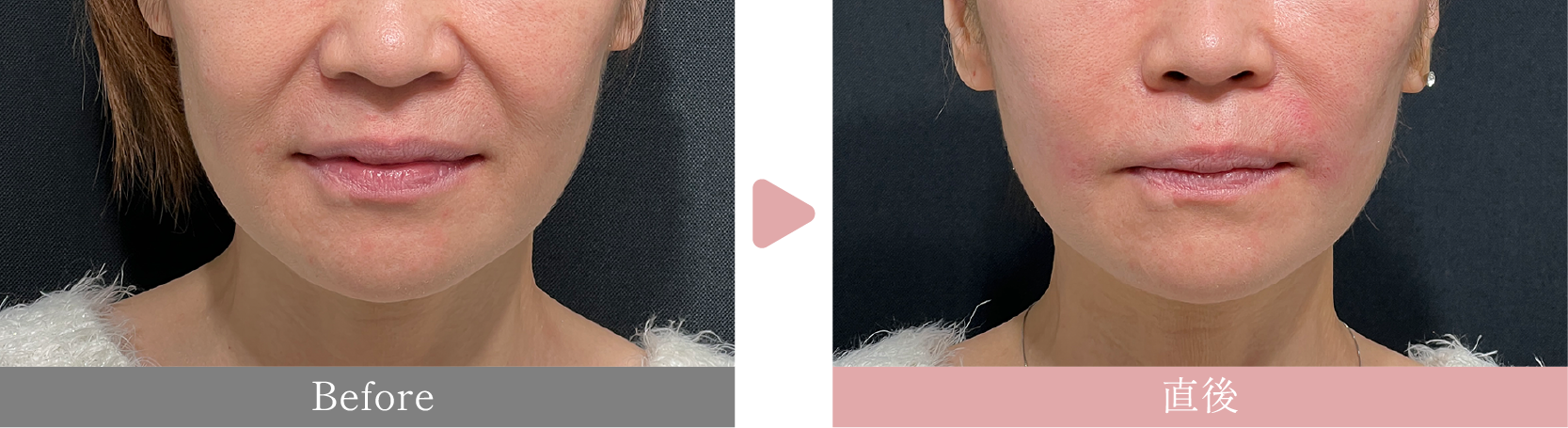 50代女性　カスタマイズ糸リフト×ほうれい線のヒアルロン酸