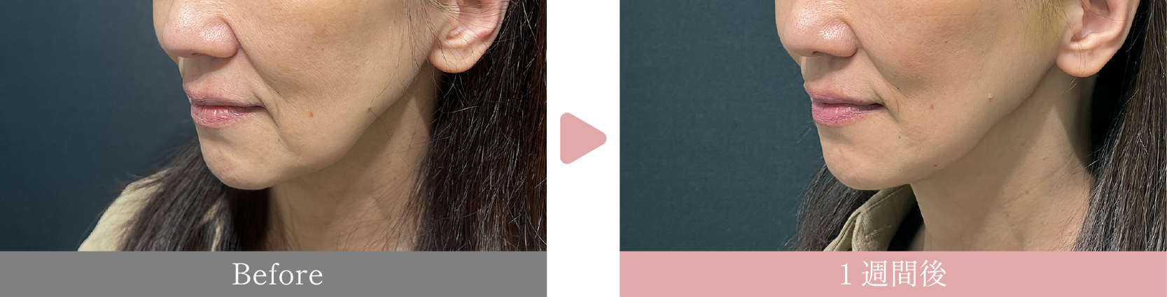 50代女性　カスタマイズ糸リフト14本