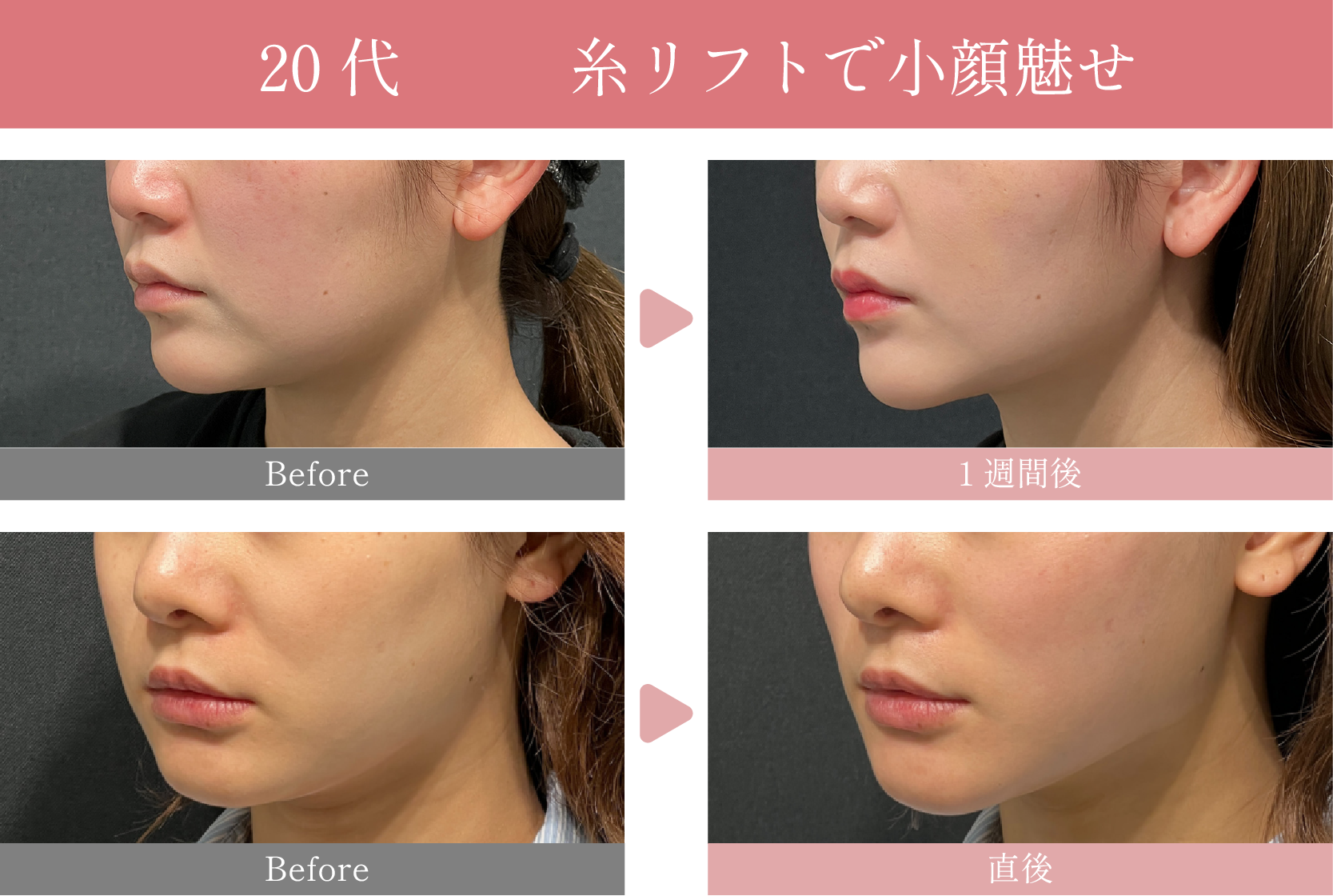 20代の糸リフト症例🤍