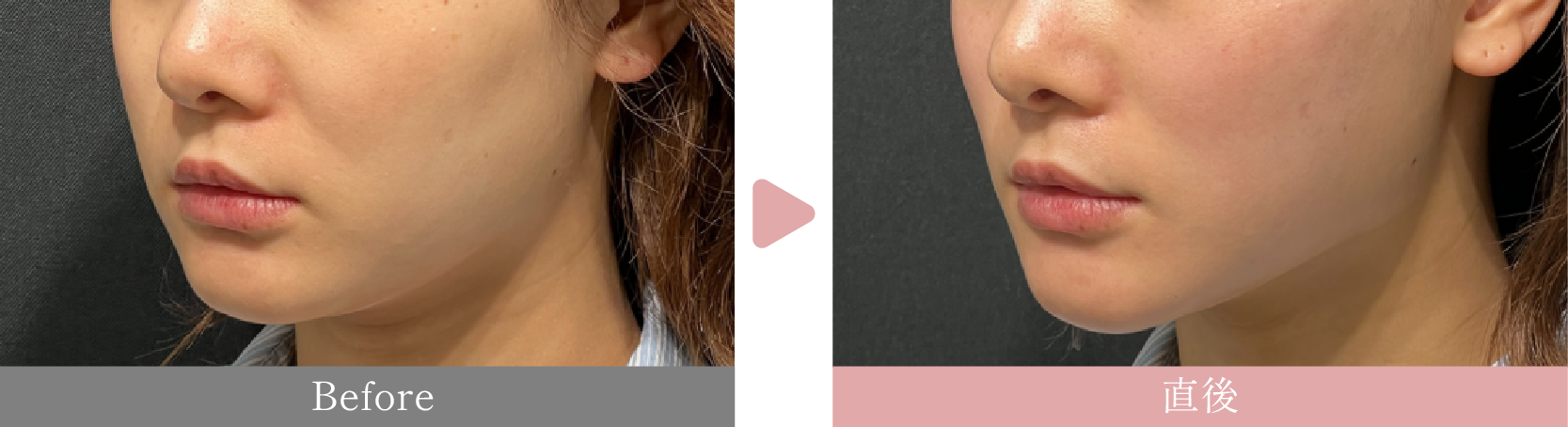 20代女性　カスタマイズ糸リフト10本