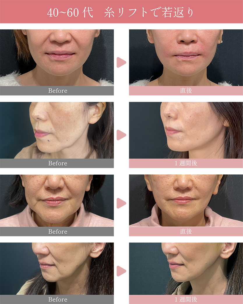 40～60代の糸リフト症例✨<br />
