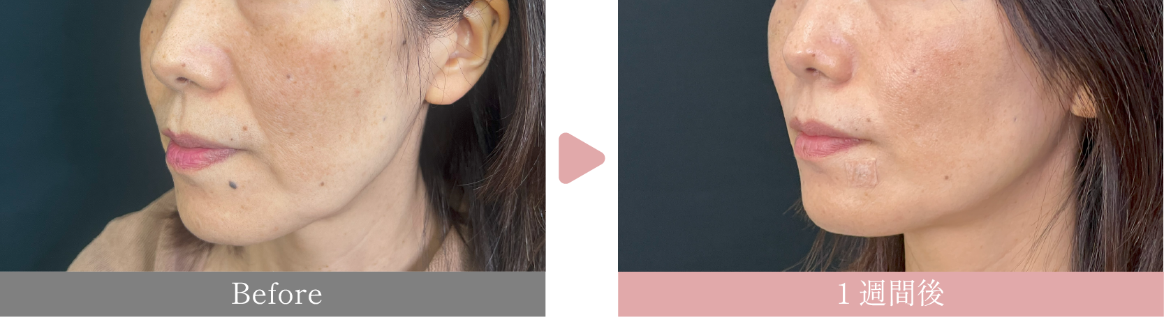 40代女性　カスタマイズ糸リフト12本×ほうれい線・口角下のヒアルロン酸