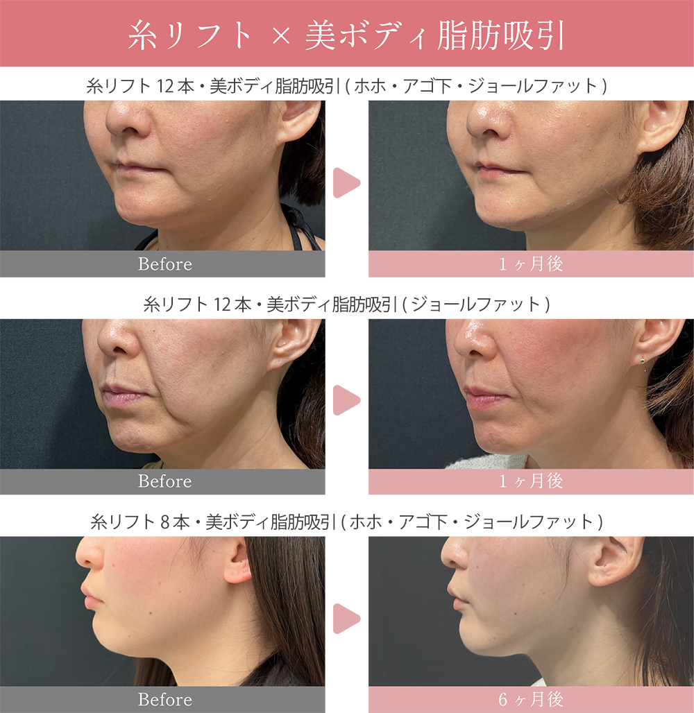 脂肪吸引との併用もおすすめです！