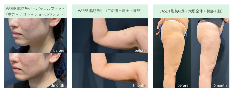 脂肪吸引の症例写真