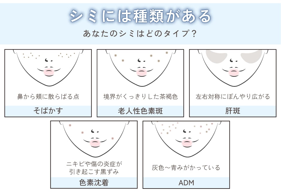 シミ・そばかすの基礎知識と主な種類を解説