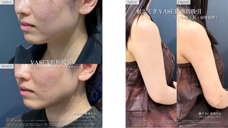 薬による体重減少と脂肪吸引による部分痩せの比較