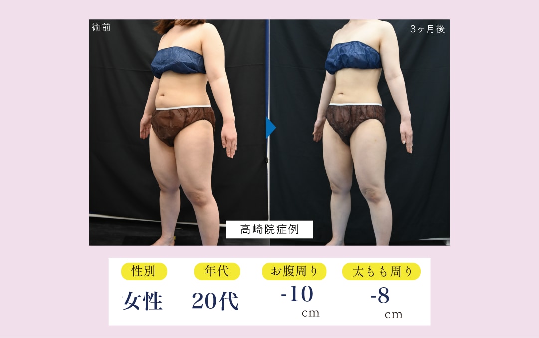 全身本気痩せプランの症例写真