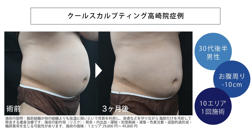 クールスカルプティング症例写真