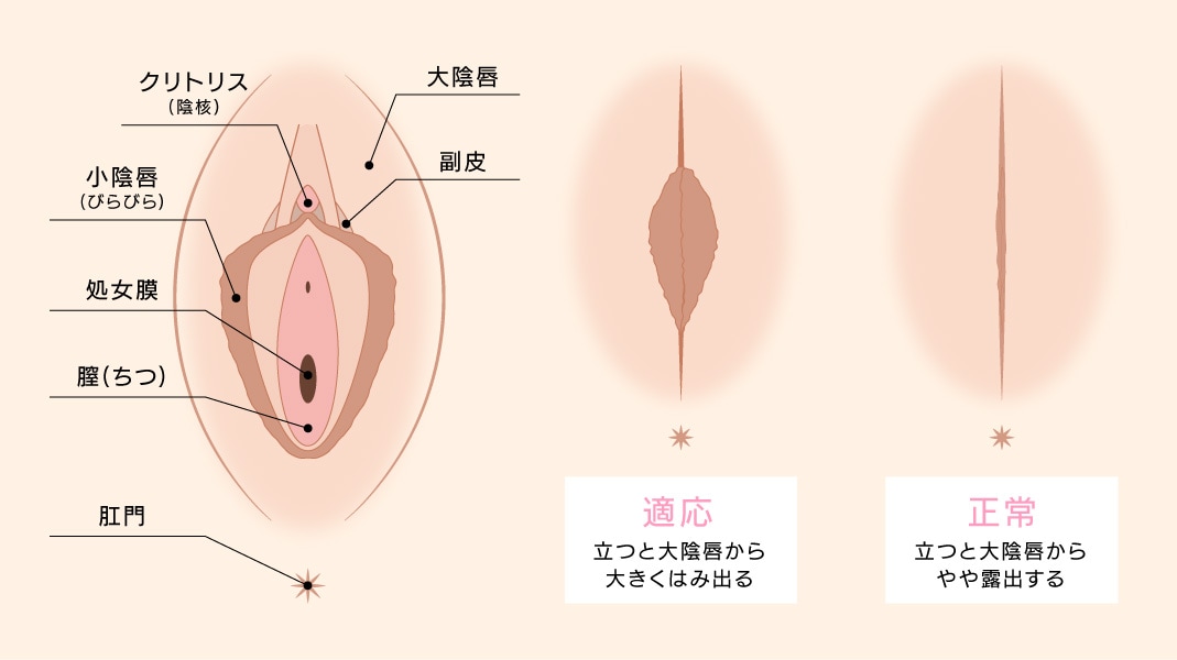 多くの場合【小陰唇縮小術(＋副皮除去)】