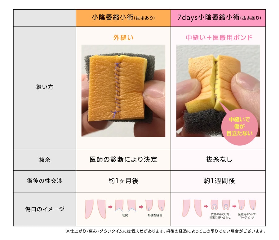 【抜糸あり】と【抜糸なし】の差は？