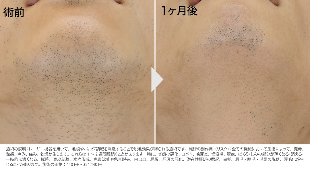 ヒゲ・全身脱毛