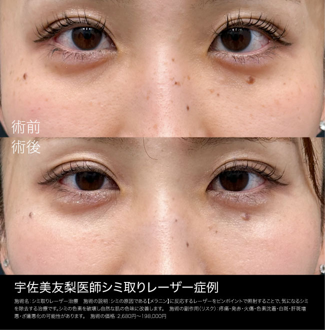【高崎院スタッフ一押し】シミ取りレーザー10