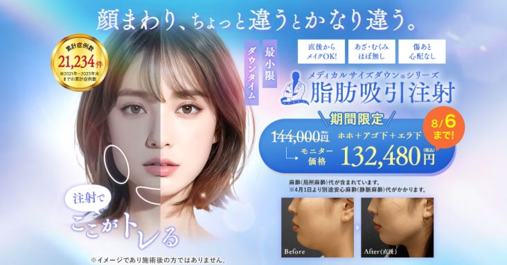 脂肪吸引注射
