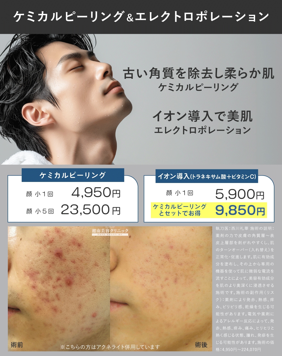 ケミカルピーリングとイオン導入
