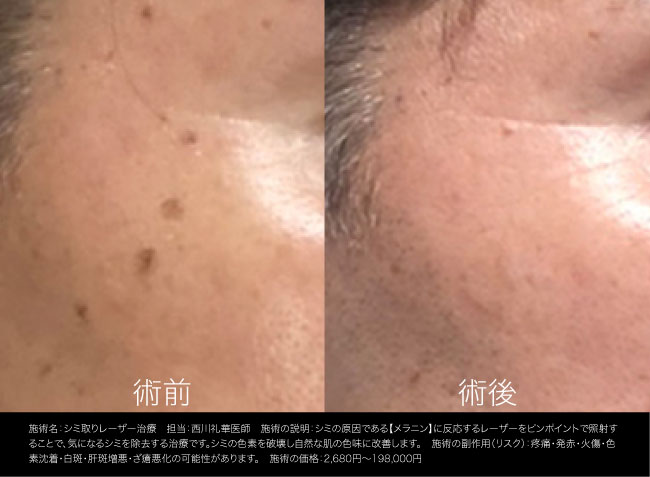 【サイズ不問3個まで】シミ取りレーザー3