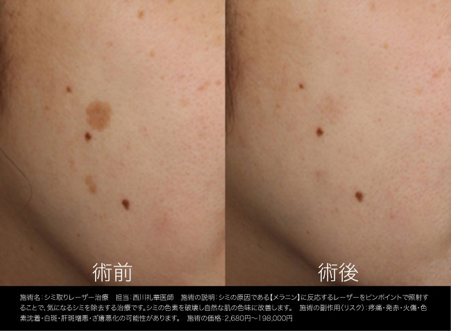 【まずは1個から】シミ取りレーザー