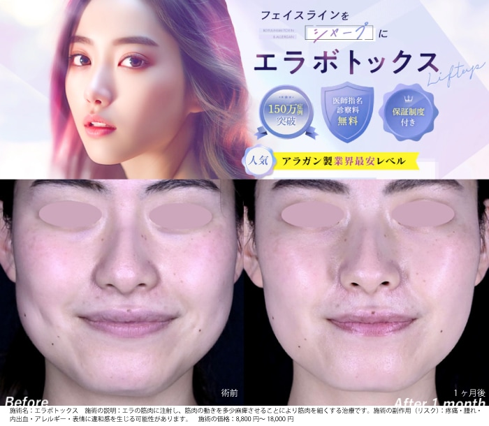 エラ張りさんには【エラボトックス】