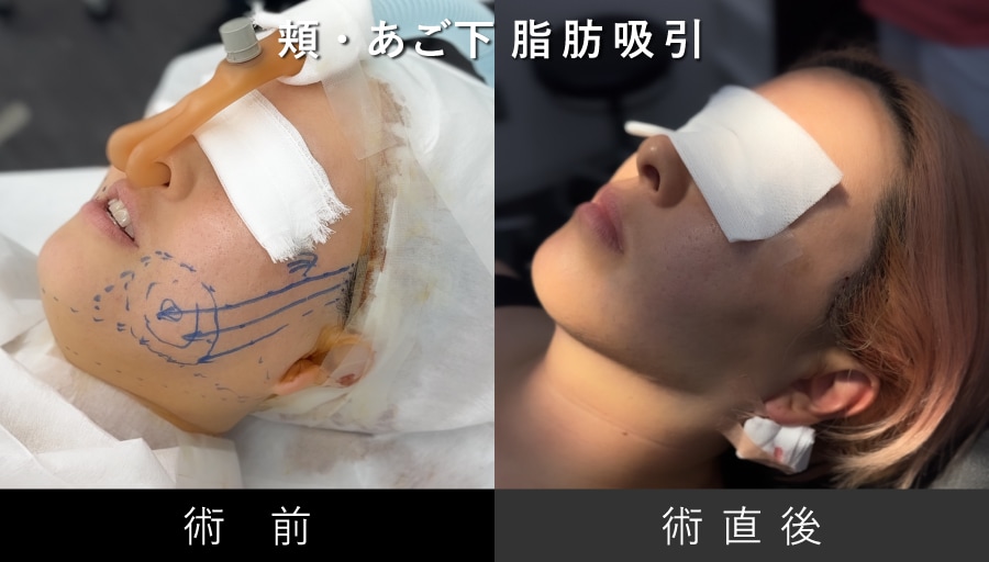 顔の脂肪吸引は、部位ごとの難易度に合わせて調整