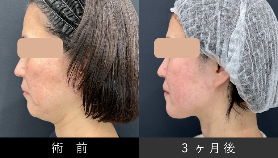 【小顔】頬・あご下の脂肪吸引＋糸リフト