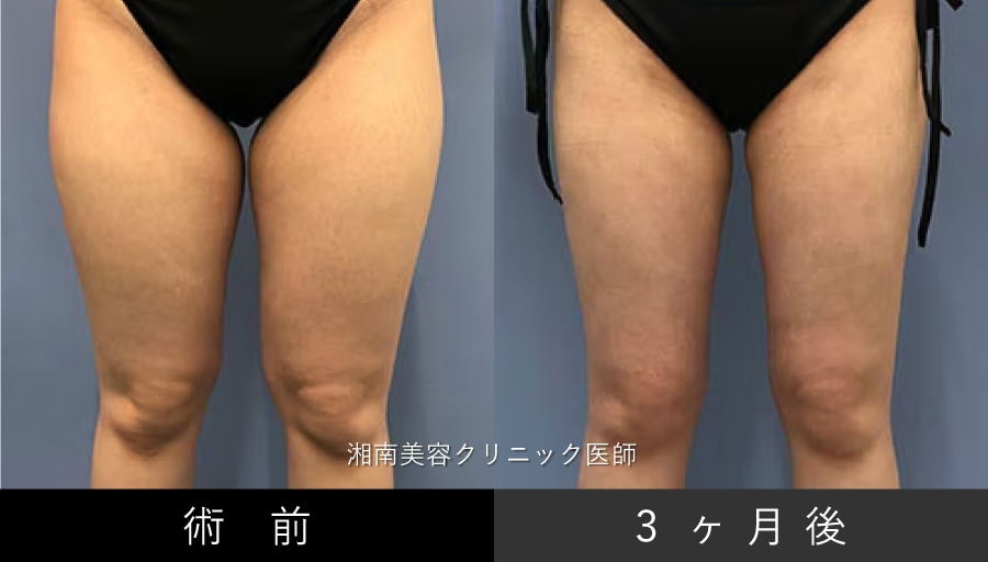 【太もも】内もも・外もも・前側・後ろ側・ひざ上まで対応