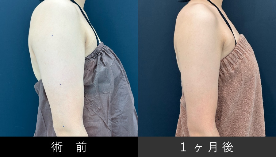 【二の腕】横・後ろ姿に自信！脂肪吸引で“振袖”解消