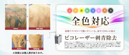 黒インク以外のタトゥーも対応可能に!