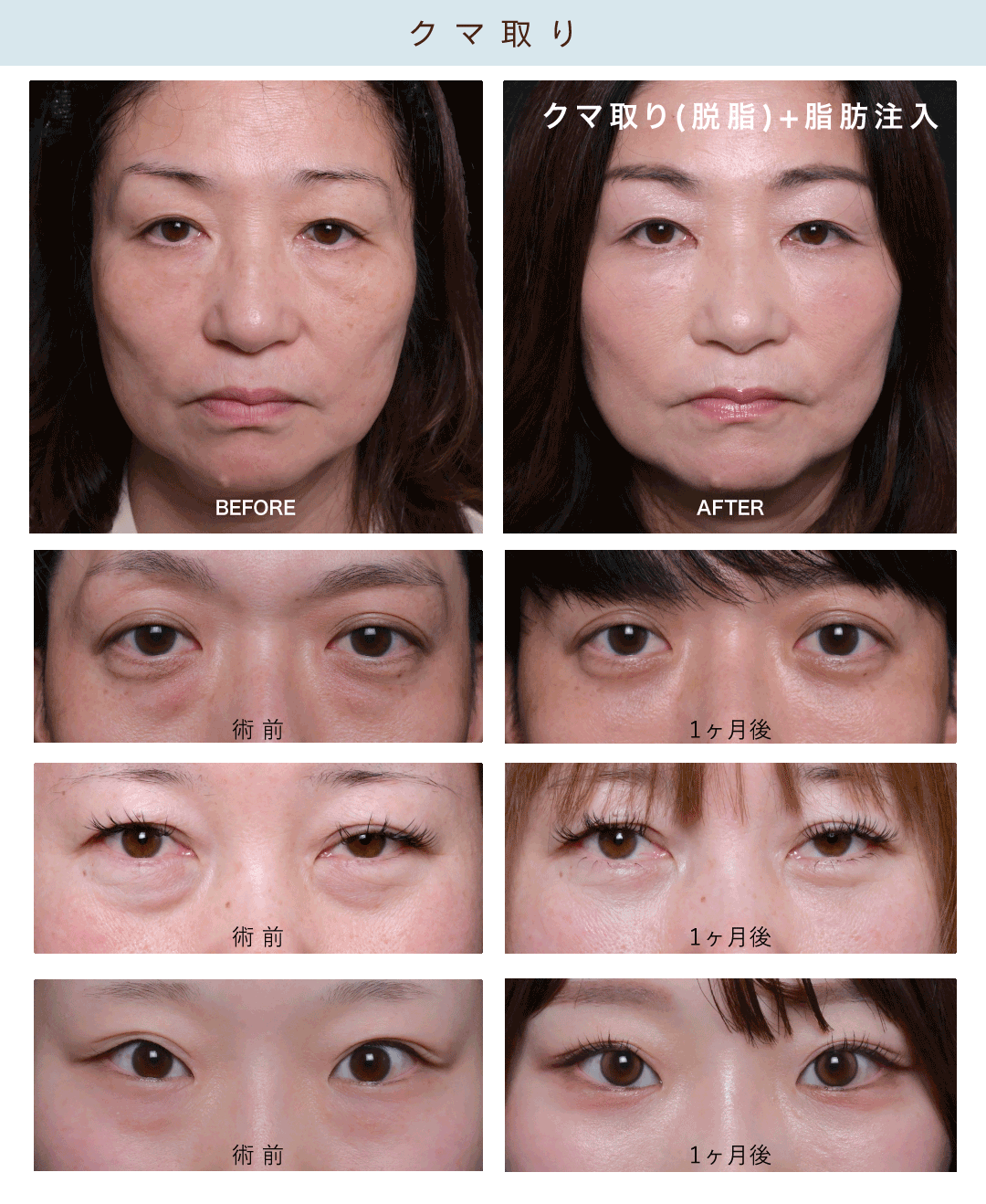 クマ取り＋脂肪注入