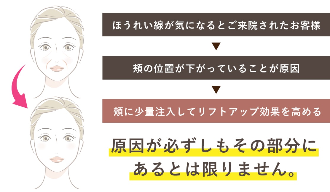 ほうれい線が気になるとご来院されたお客様