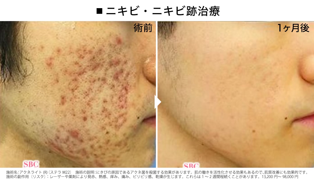 【NEW】人気のアクネライト