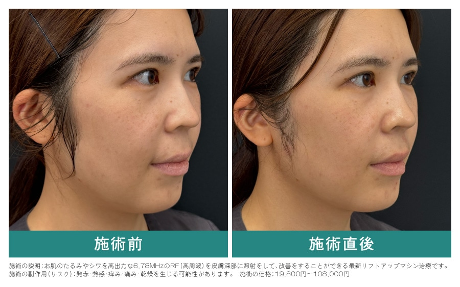 術前と術直後の比較