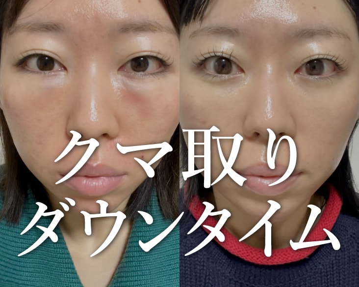 クマ取りのダウンタイムはどれくらい？腫れ・経過を症例で解説｜湘南美容クリニック高崎院